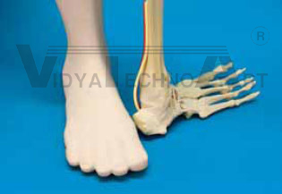 Foot 4-part, malunion, foam coat 90°